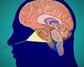 Estesioneuroblastoma-400x350