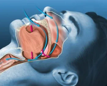 apneia-do-sono-1-400x350