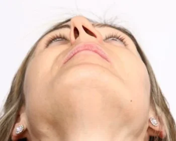 desvio-de-septo-nasal-400x350