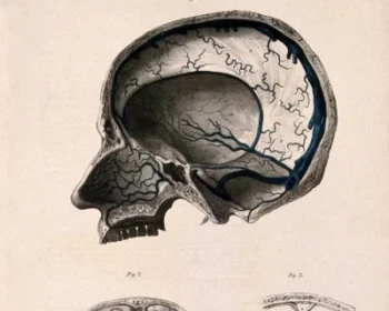 fistula-liquorica-400x350 (1)